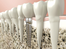 Dental Implants in Bowral